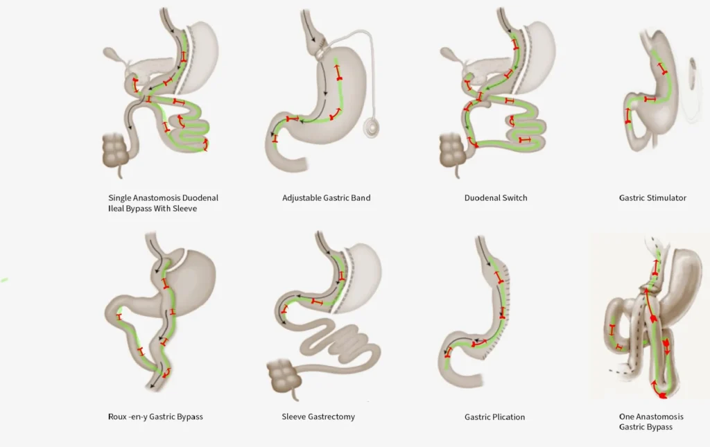 Preventing Dental Inflammation Post-Bariatric Surgery