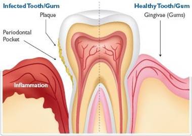 Recognizing Symptoms of Dental Inflammation