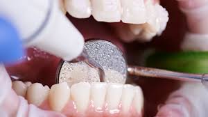 Understanding Dental Inflammation in Bariatric Patients