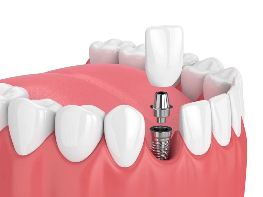 Understanding Dental Implants and Their Costs: