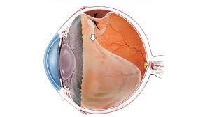 Additional Medications That May Increase Retinal Detachment Risk: