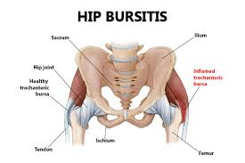 What Causes Hip Pain?