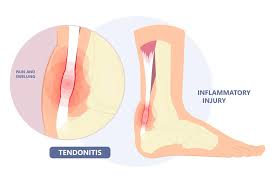 Common Causes of Tendonitis in Everyday Activities