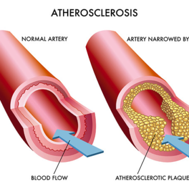 Vascular Problems and Their Impact on Overall Health