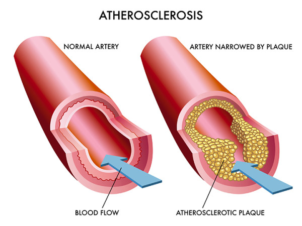 Vascular Problems and Their Impact on Overall Health