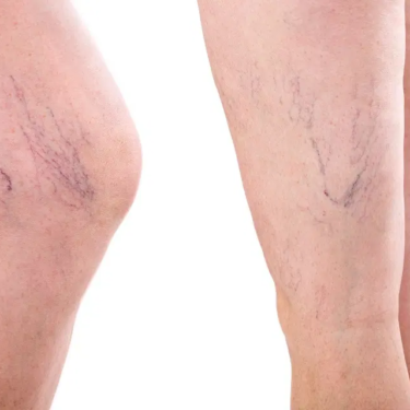 How Cosmetic Vein Treatment Can Help You Achieve Smooth, Healthy-Looking Legs