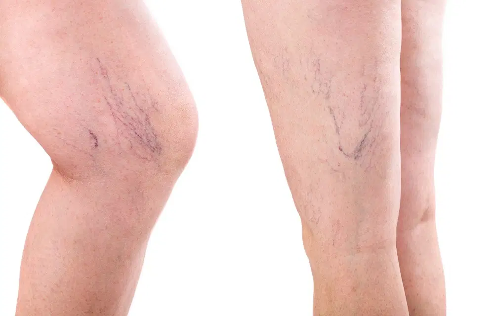 How Cosmetic Vein Treatment Can Help You Achieve Smooth, Healthy-Looking Legs