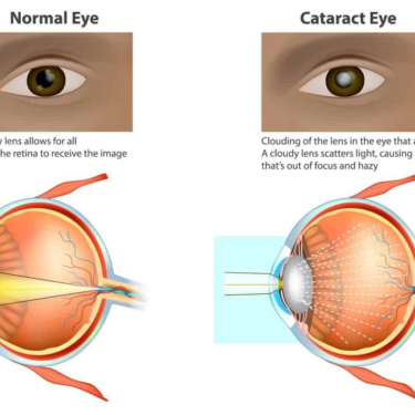 Understanding Different Types of Cataract Surgery