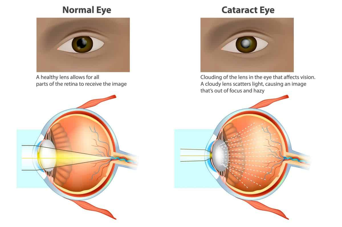 Understanding Different Types of Cataract Surgery